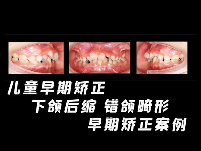 早期矫治影响正畸-图2