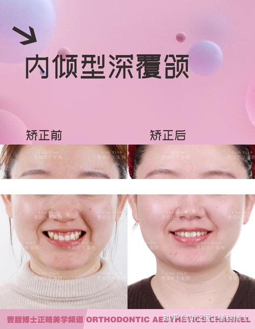 成人牙齿正畸对比-图2 成人牙齿正畸对比-图2