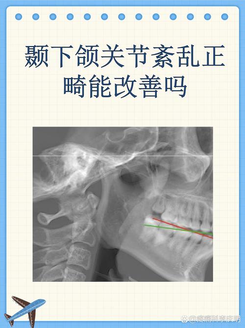 颞下颌 RW正畸-图1 颞下颌 RW正畸-图1