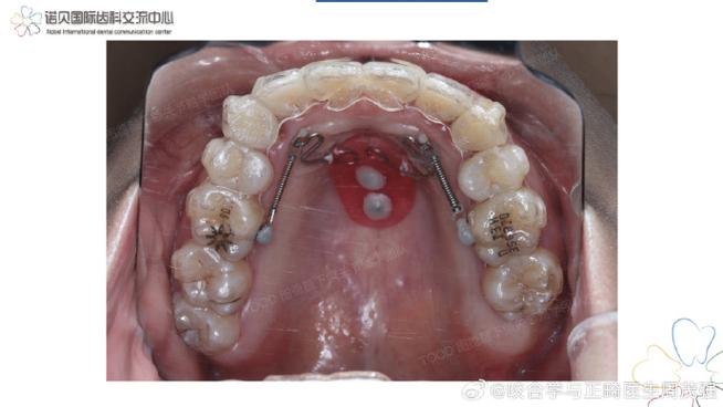 颞下颌 RW正畸-图2 颞下颌 RW正畸-图2