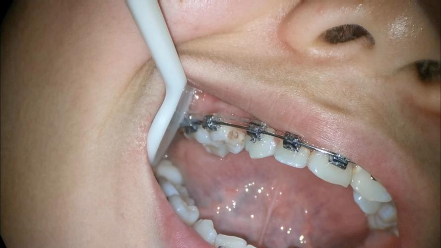 正畸期间蛀牙掉了,矫正会受影响吗?该怎么处理?-图1 正畸期间蛀牙掉了,矫正会受影响吗?该怎么处理?-图1