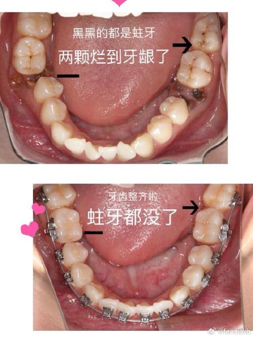 正畸期间蛀牙掉了,矫正会受影响吗?该怎么处理?-图2 正畸期间蛀牙掉了,矫正会受影响吗?该怎么处理?-图2