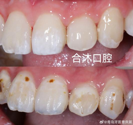 正畸期间蛀牙掉了,矫正会受影响吗?该怎么处理?-图3 正畸期间蛀牙掉了,矫正会受影响吗?该怎么处理?-图3