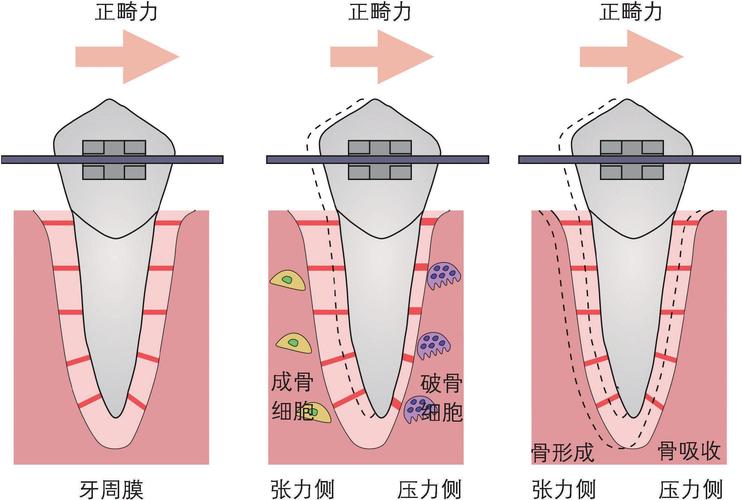 正畸牙齿移动原理-图1 正畸牙齿移动原理-图1