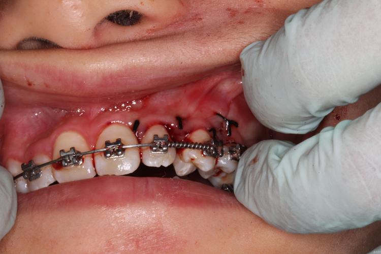 正畸拔牙为何要拔尖牙？影响美观和功能吗？-图2