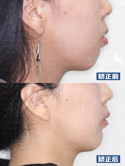 武汉凸嘴正畸牙齿，矫正效果如何？能改善凸嘴吗？-图1