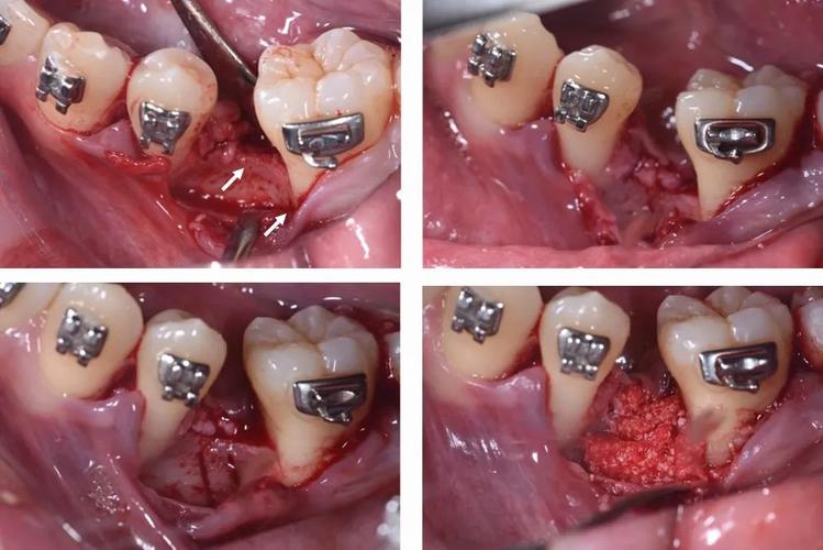 牙齿正畸关闭间隙-图1