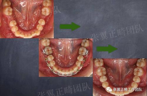 牙齿正畸关闭间隙-图2