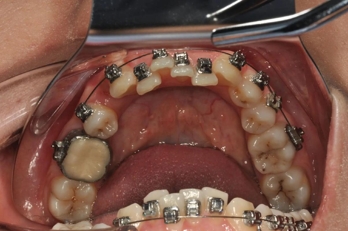 正畸带分牙器带环-图1