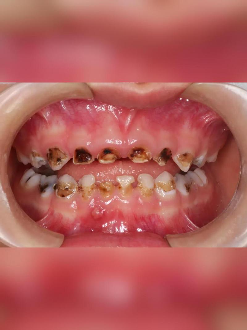 牙齿正畸出现虫牙-图1 牙齿正畸出现虫牙-图1