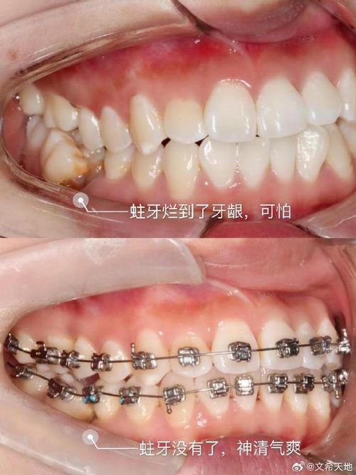 牙齿正畸出现虫牙-图2 牙齿正畸出现虫牙-图2