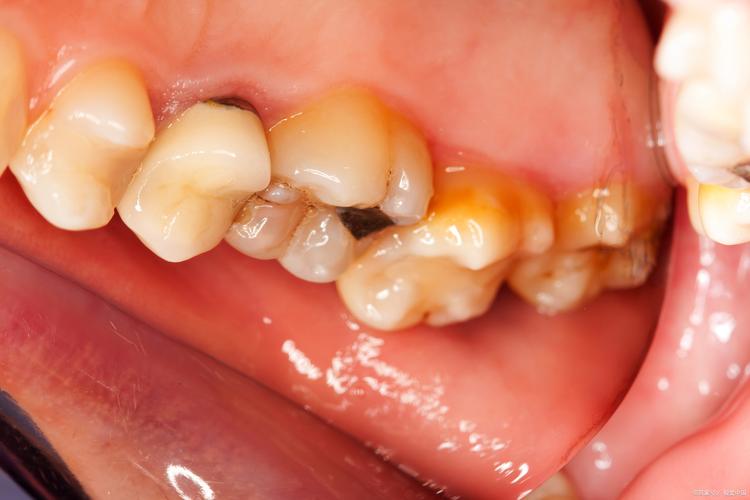 牙齿正畸出现虫牙-图3 牙齿正畸出现虫牙-图3
