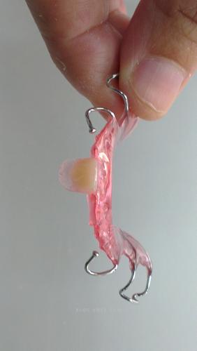 口腔正畸导板图片-图2