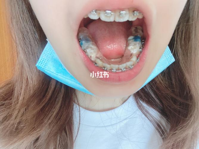 正畸时大牙为什么要垫起来？-图3