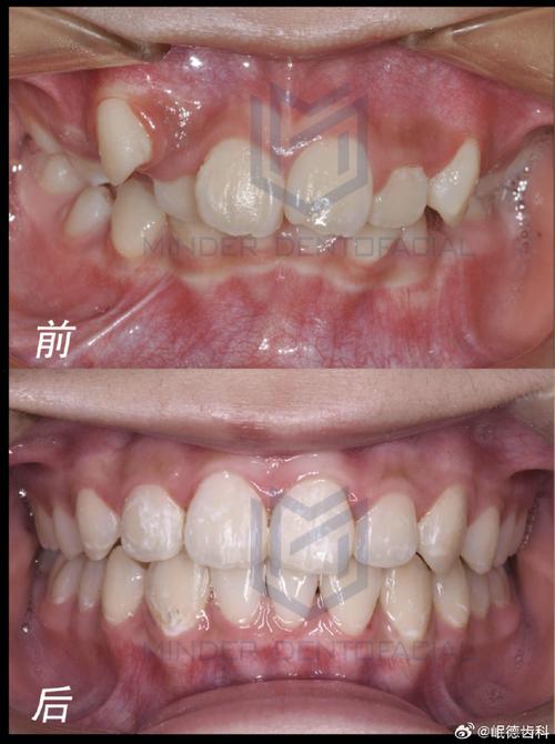 华西正畸前后对比-图2
