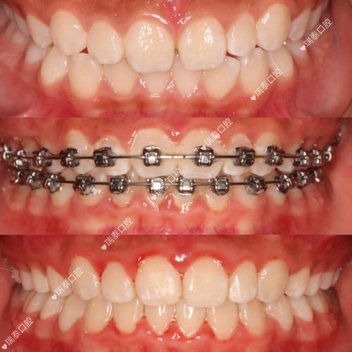 牙齿正畸spee-图1 牙齿正畸spee-图1