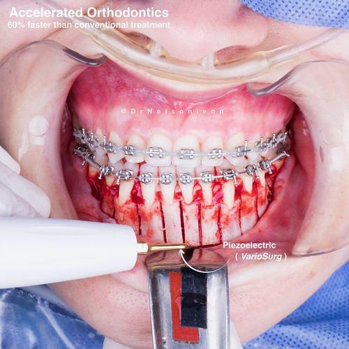 PAOO加速正畸效果如何？能显著缩短治疗时间吗？-图1