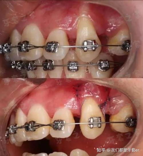 PAOO加速正畸效果如何？能显著缩短治疗时间吗？-图2