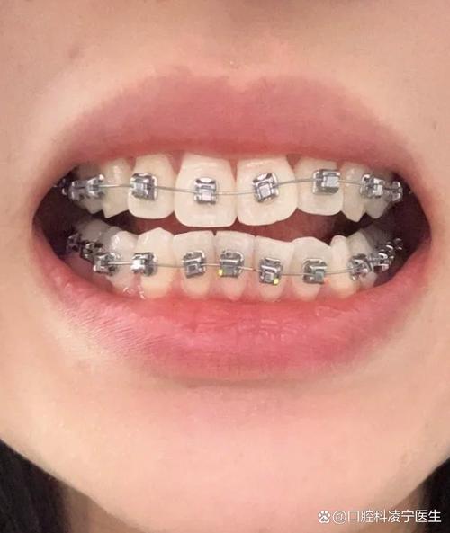 单晶 正畸 不好-图2 单晶 正畸 不好-图2