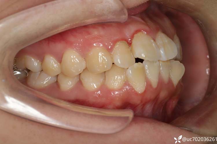 拔牙正畸会影响老了后的牙齿健康吗？-图2