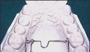 铸造TPA 正畸-图1