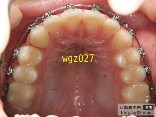 DamonQ正畸-图2