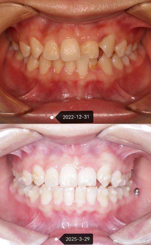 正畸中Bolton指数异常会影响矫正效果吗？-图2