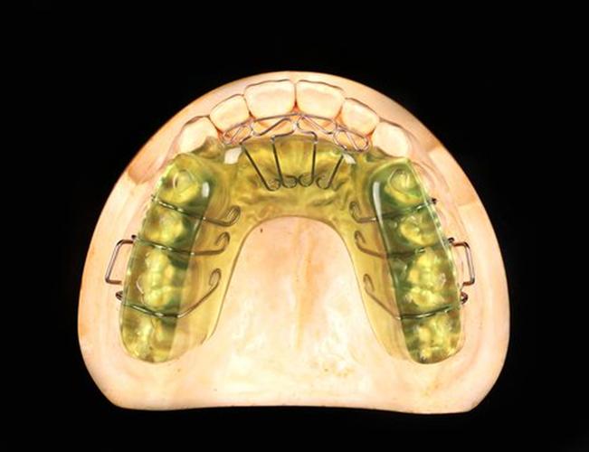 正畸中Bolton指数异常会影响矫正效果吗？-图3