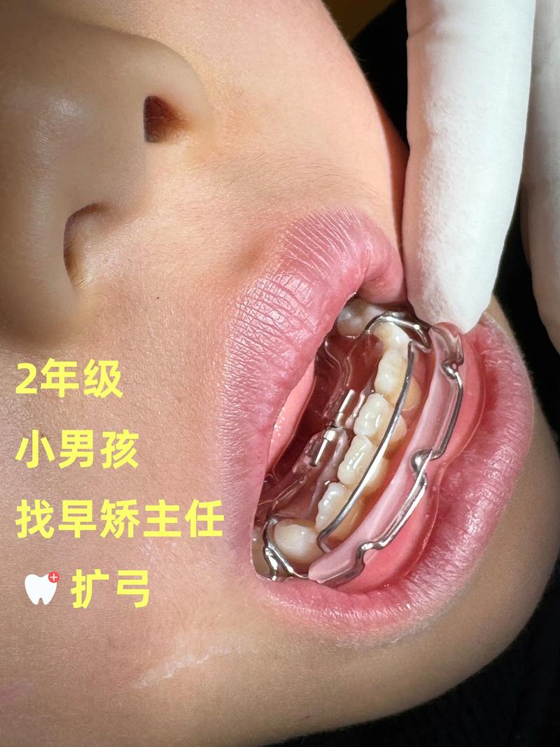 正畸牙套掉了怎么办？紧急处理和就医时机要注意啥？-图1