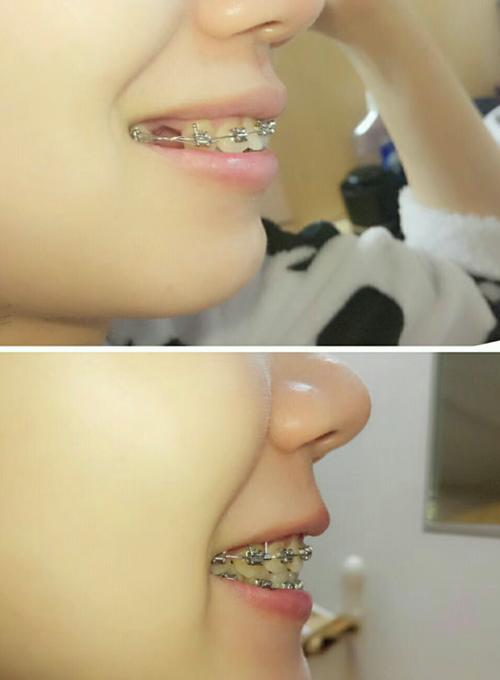 正畸拔一颗下切牙-图3