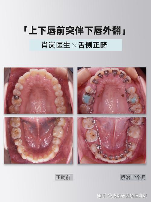 四川成都做舌侧正畸效果好不好?-图1 四川成都做舌侧正畸效果好不好?-图1