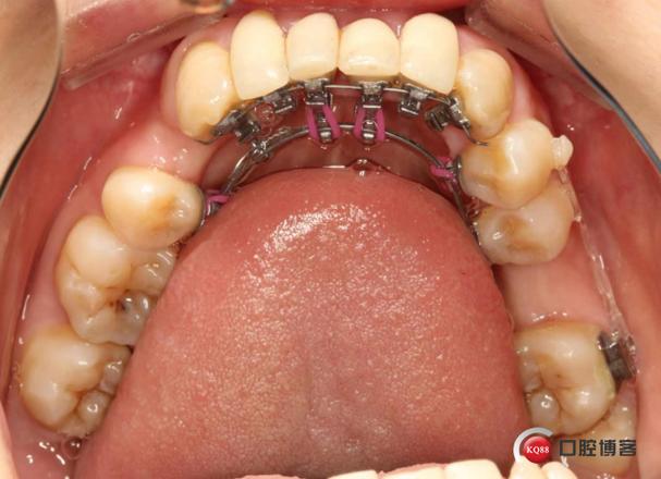 四川成都做舌侧正畸效果好不好?-图2 四川成都做舌侧正畸效果好不好?-图2