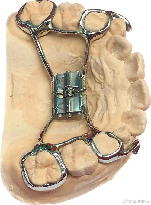 正畸前方牵引器图-图3 正畸前方牵引器图-图3