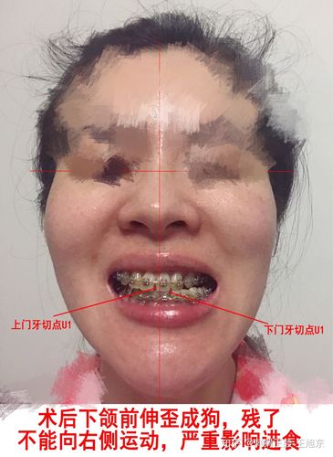 叶翁三杰正畸失败-图2