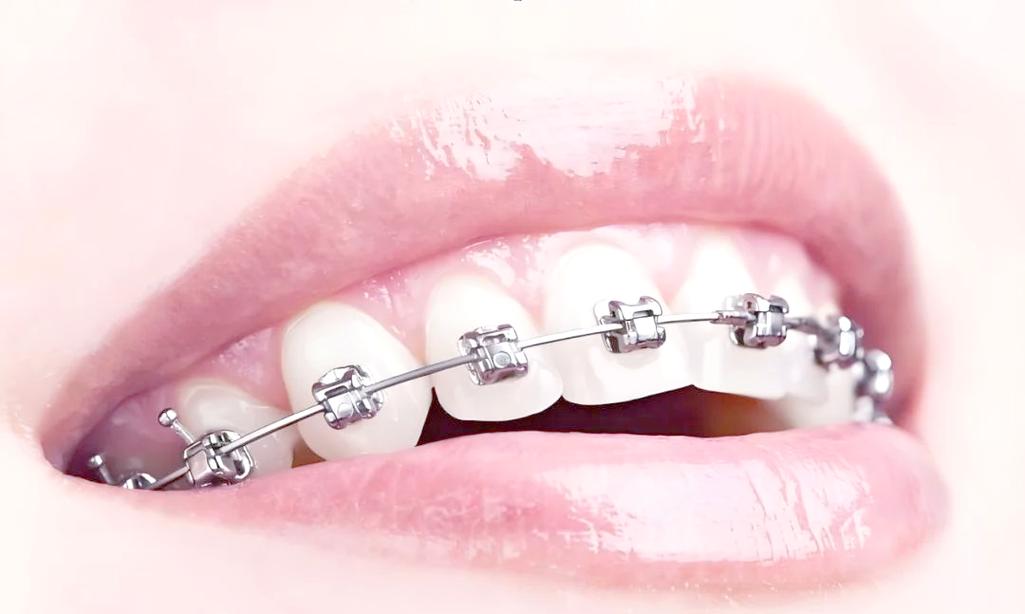 正畸中的牙齿片切-图1 正畸中的牙齿片切-图1