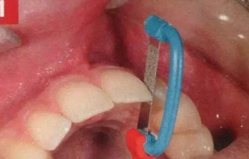正畸中的牙齿片切-图3 正畸中的牙齿片切-图3