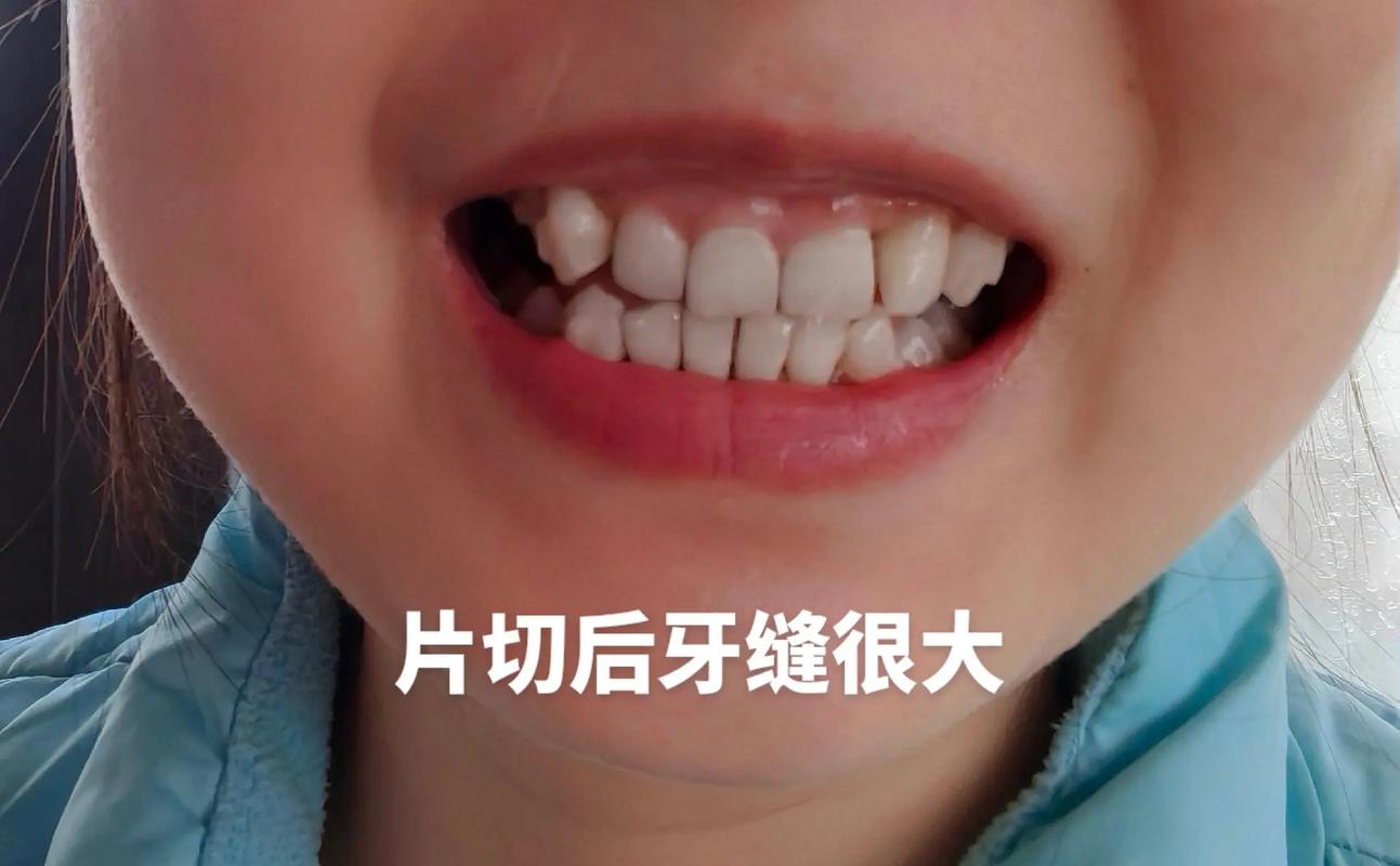 正畸中的牙齿片切-图2 正畸中的牙齿片切-图2