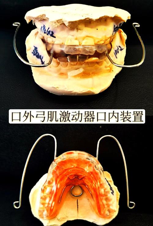 口腔正畸一类牵引-图2