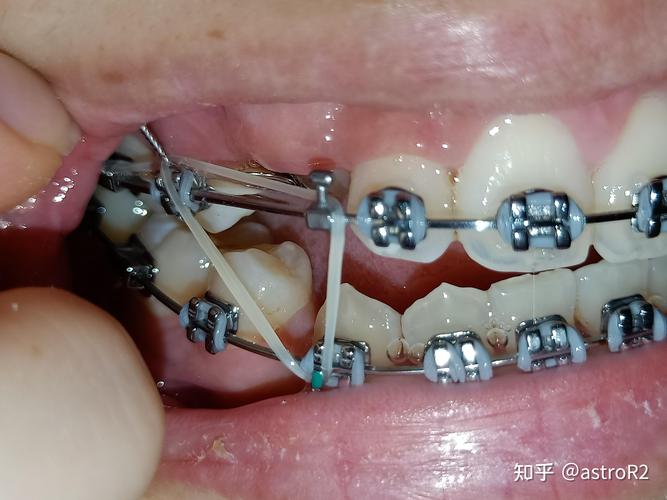 口腔正畸一类牵引-图3