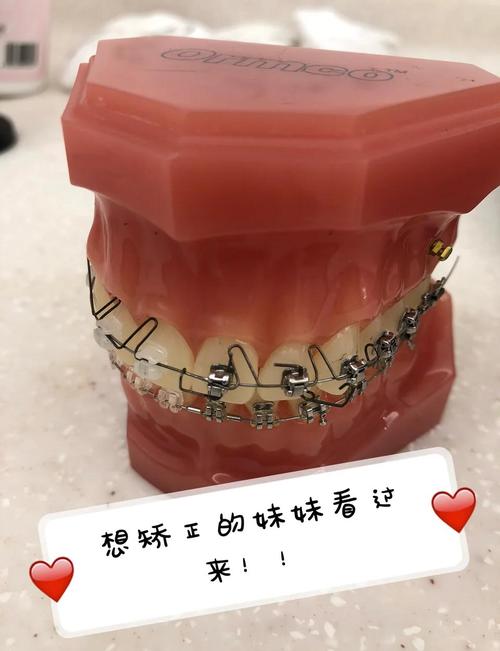 正畸托槽上下左右-图2 正畸托槽上下左右-图2