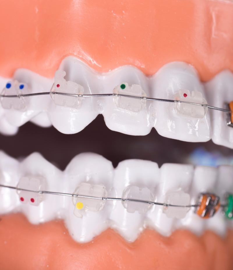 正畸托槽上下左右-图3 正畸托槽上下左右-图3