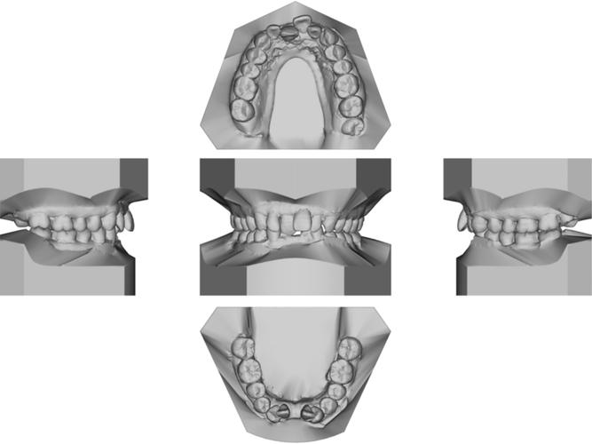 牙周病患者正畸，联合治疗如何兼顾健康与美观？-图3
