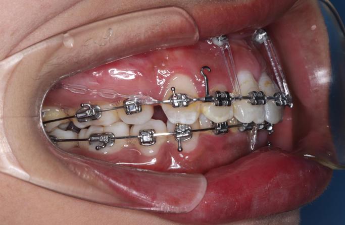 完全远中关系正畸,矫正难点与效果如何实现?-图3 完全远中关系正畸,矫正难点与效果如何实现?-图3