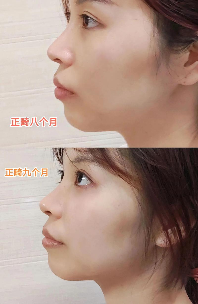 正畸水平曲的调整-图2
