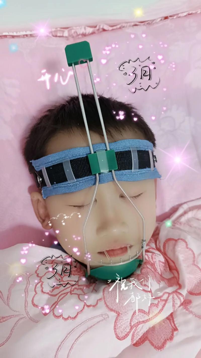 正畸牵引牙齿疼吗-图1