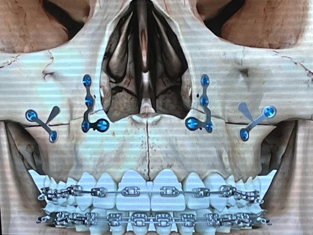 口腔正畸偏额手术-图2