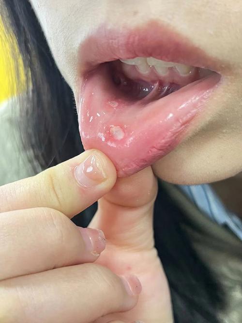 正畸初期口腔溃疡-图2 正畸初期口腔溃疡-图2