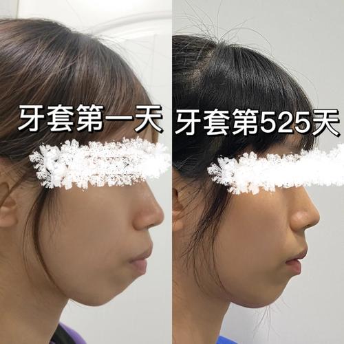 正颌正畸前后对比，脸型和咬合变化究竟有多显著？-图3