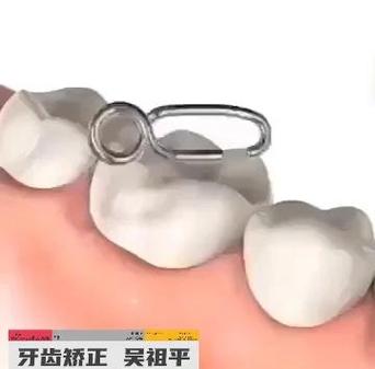 口腔正畸带环方向如何精准把控?影响矫治效果的关键因素?-图3 口腔正畸带环方向如何精准把控?影响矫治效果的关键因素?-图3