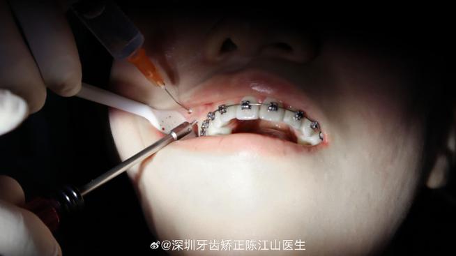 深圳牙齿正畸经历如何？效果、过程、费用大揭秘？-图1